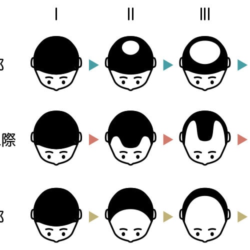 進行性であるAGA