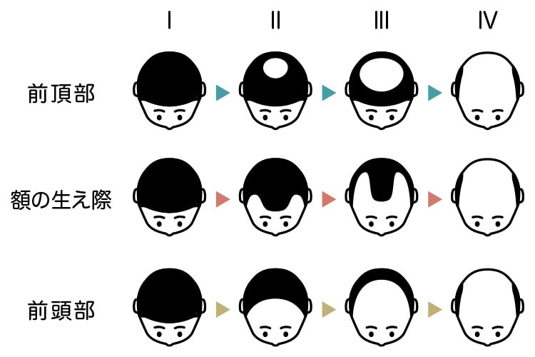 AGA、「男性型脱毛症」の主な症状