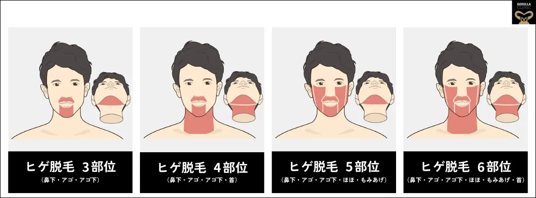 ヒゲ脱毛はモテに効く？“全部ツルツル”はもう古い！最新トレンド＆医師のリアル解説