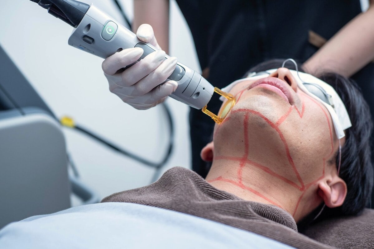 ヒゲ脱毛はモテに効く？“全部ツルツル”はもう古い！最新トレンド＆医師のリアル解説